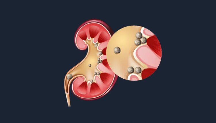 The Science Of Citric Acid Understanding How It Can Help Prevent   Kidney Stones 750x430 